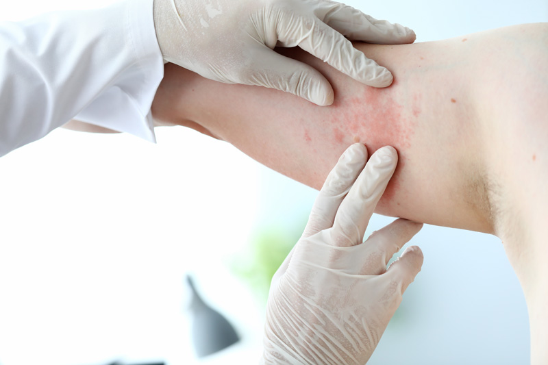 Male doctor in white protective gloves examing patient Dermatology Clinic in Cheyenne, WY